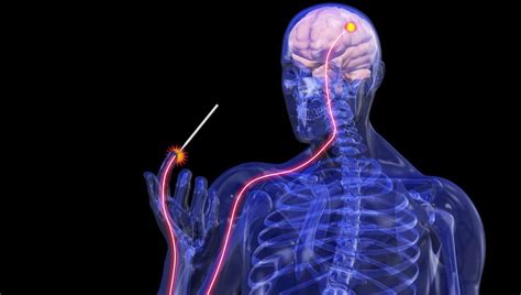 Rare case of Hereditary Sensory and Autonomic Neuropathy Type II in ...