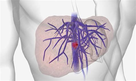 Premium Photo | Portal vein thrombosis pvt is the occlusion of the portal vein by a blood clot ...