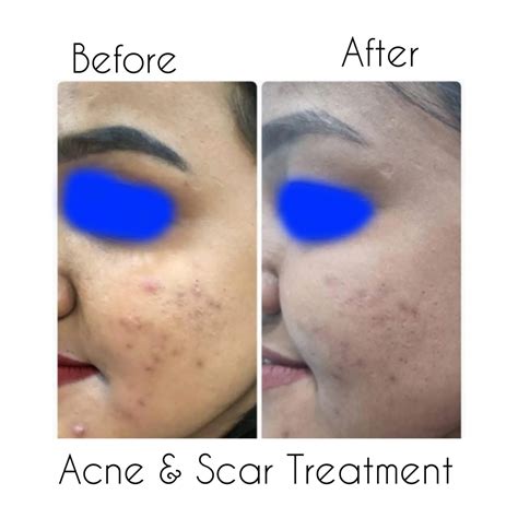 Best Acne Scars Treatment in Kolkata - Cost, Procedures & Results - La Derma