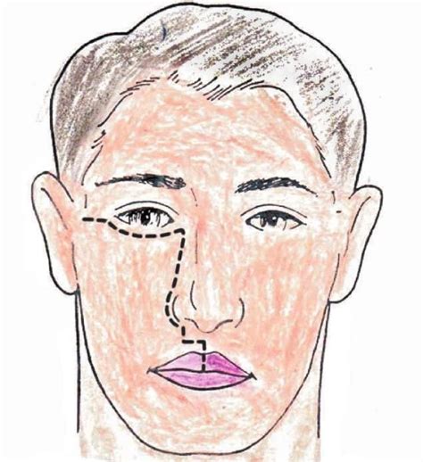 Tumours of Nose and PNS Chapter Notes - Ear Nose Throat (ENT) - NEET PG