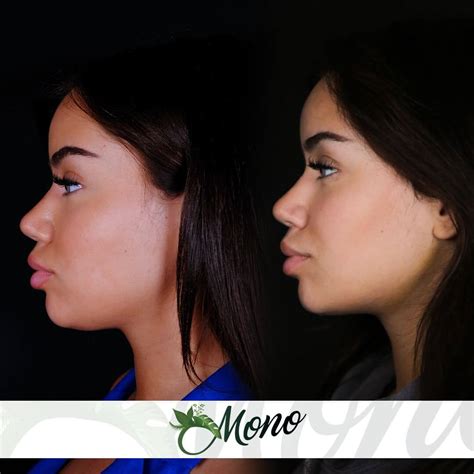 Double Chin Liposuction in Clinic Mono in 2025