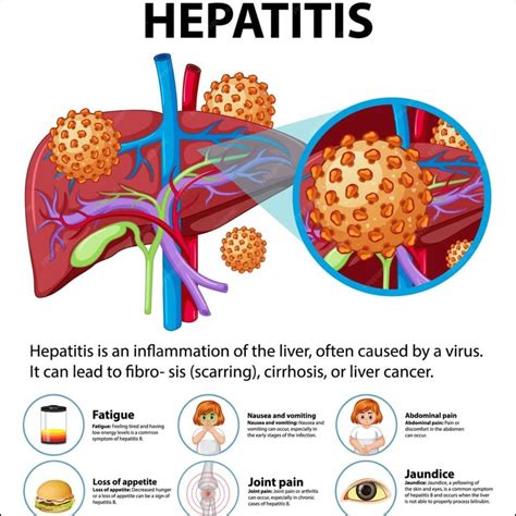 Hepatitis Stool