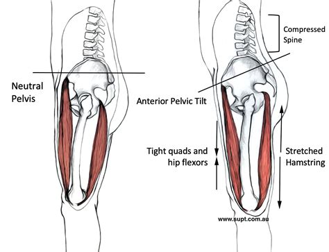 What is an ‘Anterior Pelvic Tilt’ and How to Correct it. — BodyWork