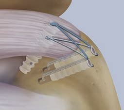 Image result for Rotator Cuff Repair Photo