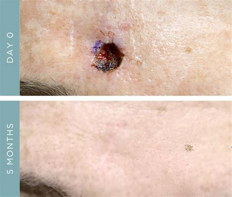 Mohs Surgery Scar Reduction: How to Avoid Scarring on the Face
