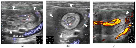 A Pediatric Case of Inverted Meckel’s Diverticulum Presenting with ...