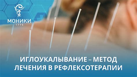 Иглоукалывание – метод лечения в рефлексотерапии | МОНИКИ - YouTube