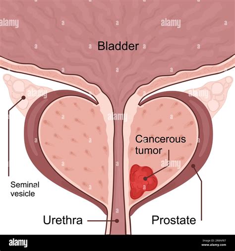 Prostate Cancer Images