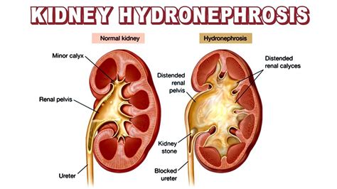psoriasis kidney