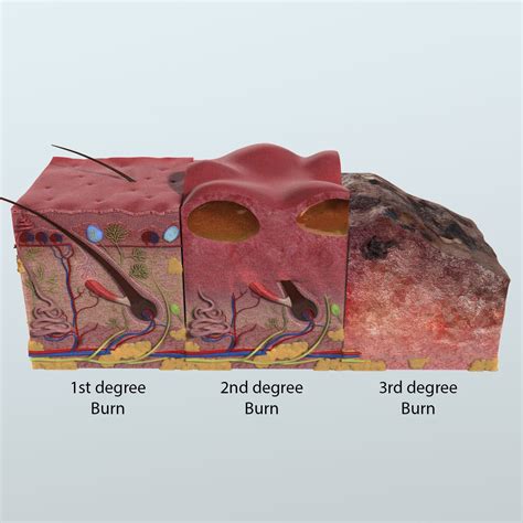 3rd Degree Burn Diagram