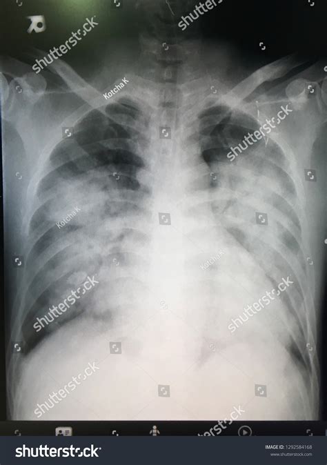 520 Acute Chest Syndrome Images, Stock Photos & Vectors | Shutterstock