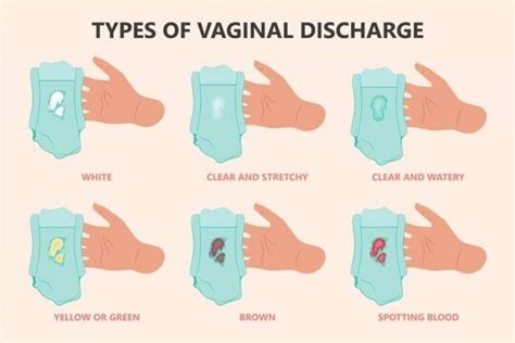 Is White Discharge Before Period Sign of Pregnancy? 5 Best Causes of ...