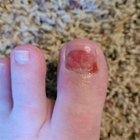Post-op Nail Removal Infection? : r/Ingrown_Toenails