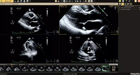 Ultrasound Workspace | Philips