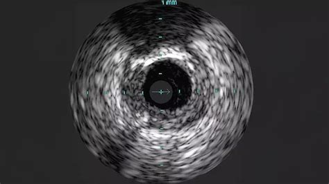 Eagle Eye Platinum Digital IVUS catheter | Philips Healthcare
