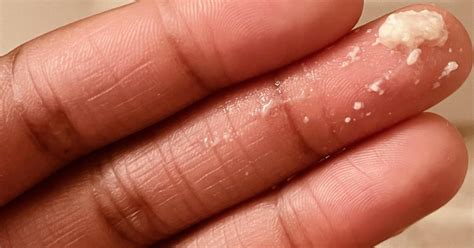 Clumpy Discharge 的图像结果