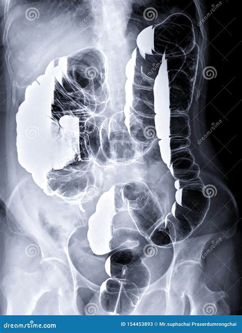 Left Lateral Decubitus Position