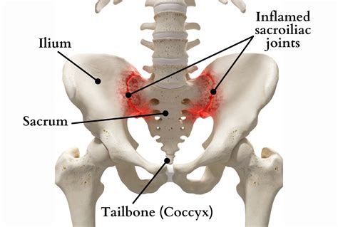 Sacral Bone Pain: Causes and Relief