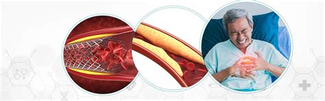 Symptoms of Blocked Artery: Causes, Treatment & Prevention