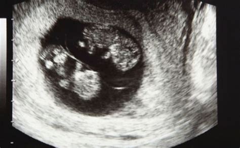 怀孕4个月胎儿B超图_孕期知识_育儿_99健康网
