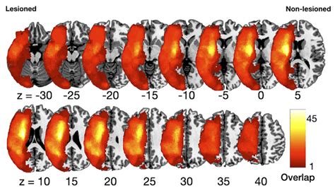 Brain Connectivity Affecting Gait Function after Unilateral ...