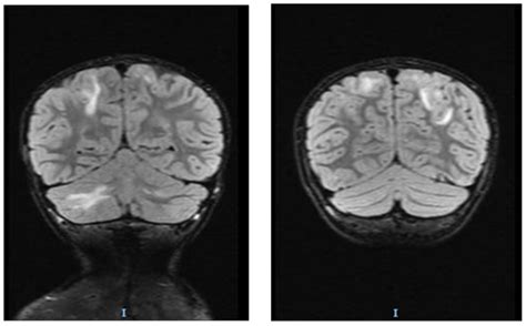 Posterior Reversible Encephalopathy Syndrome in a Pediatric Patient ...