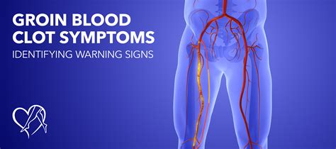 Treating Groin Pain In Women