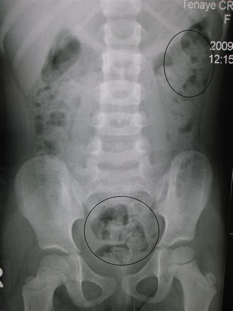 Normal Abdominal X Ray Gasless Abdomen In The Adult: What Does It