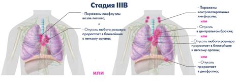 Рак легких 3 стадии: особенности, симптомы и лечение
