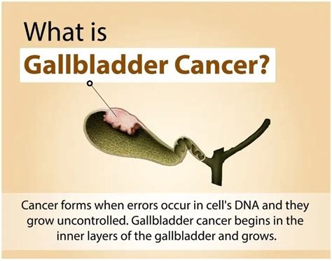 Gallbladder Cancer Treatment and Surgery | Dr. Nikhil Agrawal | Best in ...