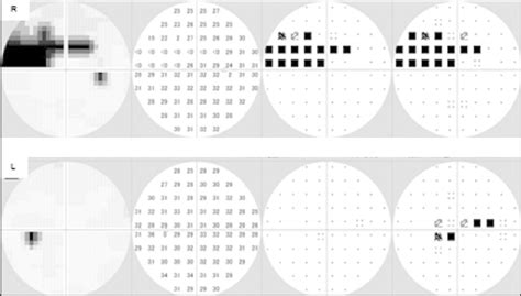 Image result for Paracentral Visual Field Defect