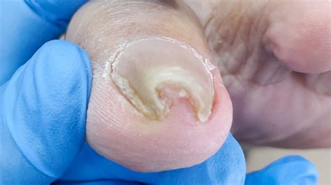 Curled Toenails Fix 的图像结果