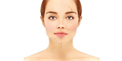 Image result for Solar Comedones Extraction