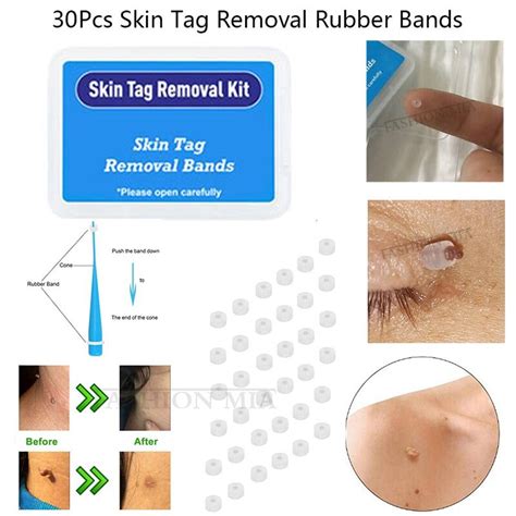 Skin Tag Remover Micro Mole Wart Removal Tool With 50 20 10 X Bands 春の ...