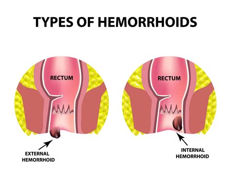 Thrombosed Hemorrhoid Vs Regular Hemorrhoid