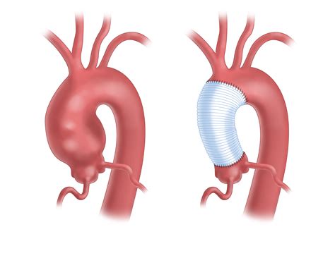 Ascending and Aortic Arch Aneurysm Symptoms and Repair | UPMC