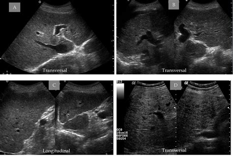 Ultrasonic Imaging in Liver Disease: From Bench to Bedside | IntechOpen