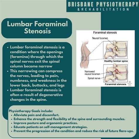 What Is Lumbar Foraminal Stenosis? - Brisbane Physiotherapy & Podiatry