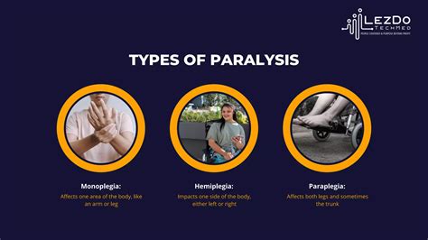 Insights on Different Types of Paralysis | PPTX