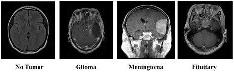 Empowering Brain Tumor Diagnosis through Explainable Deep Learning