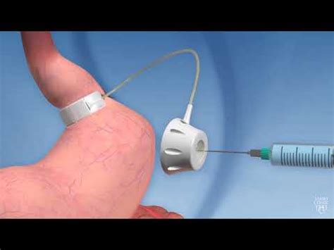 Why Exercise Matters After Laparoscopic Adjustable Gastric Banding Surgery