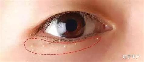 在眼睛旁边的脂肪粒怎么消除？弄掉后会复发？整形医生为你详细解析 | 说明书网