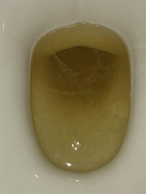 24M Noticed these small bubbles/ tiny particles in urine for past few ...