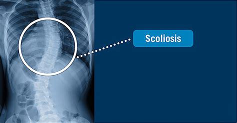 Scoliosis - USA Spine Care - Laser Spine Surgery