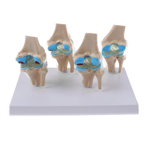 ⚡️Buy Maxbell Human Pathological Knee Joint Health Lesion Comparison ...