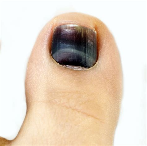 Why Do Toenails Turn Black And Blue at Don Pursel blog