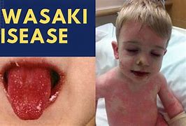 Image result for Kawasaki Disease