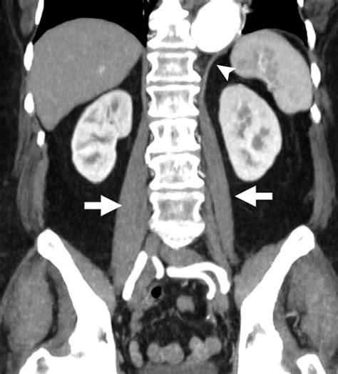 The Diaphragmatic Crura and Retrocrural Space: Normal Imaging Appearance, Variants, and ...