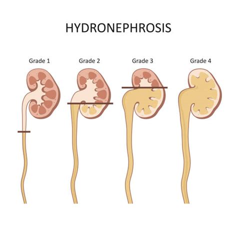 Image result for Nephrohydrosis Algorithm