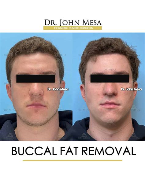 Buccal Fat Removal Celebrities 60 Photos - Moonagedaydream.film